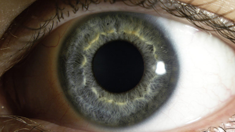 https://upload.wikimedia.org/wikipedia/commons/8/87/Iris_cornea_adnexa_-_biomicroscope.jpg