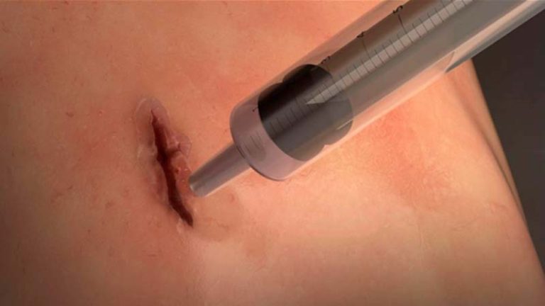 http://www.ctvnews.ca/health/new-super-flexible-surgical-glue-can-seal-wounds-in-seconds-study-1.3620138